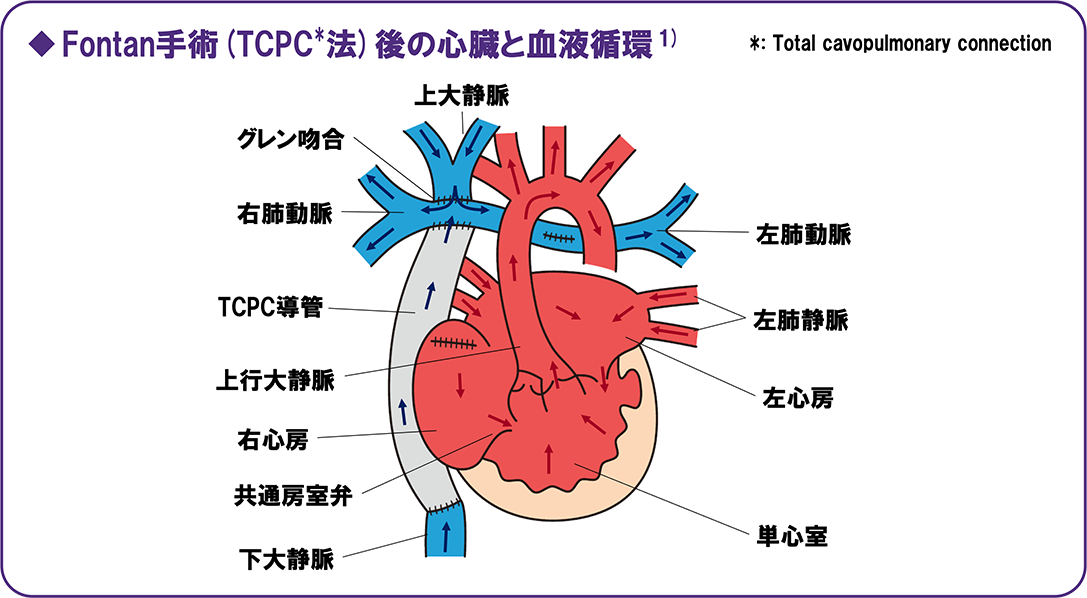 小児Fontan術後：Fontan手術(TCPC法)後の心臓と血液循環