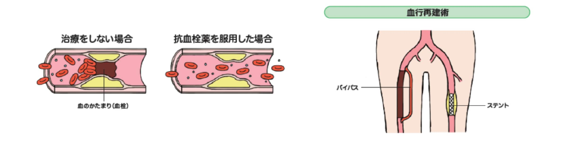 PADの薬物療法にはどのようなものがありますか？